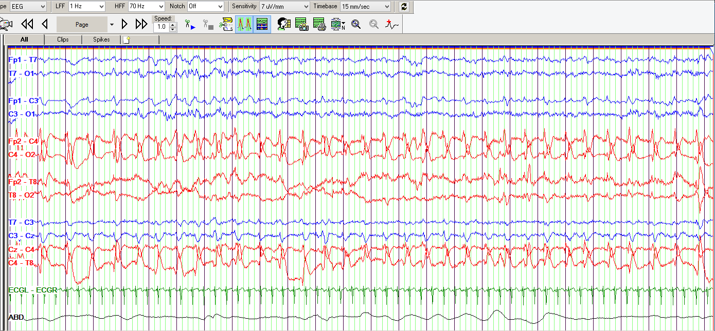 Right central seizure in a neonate with hypoxic-ischemic encephalopathy