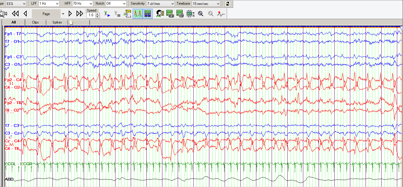 Early detection of seizures in infants crucial to brain